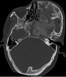 我院完成高难度颅底骨纤维异常增生症切除术